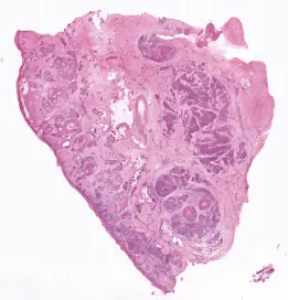 Full-field brightfield image of a squamous cell carcinoma shave biopsy.